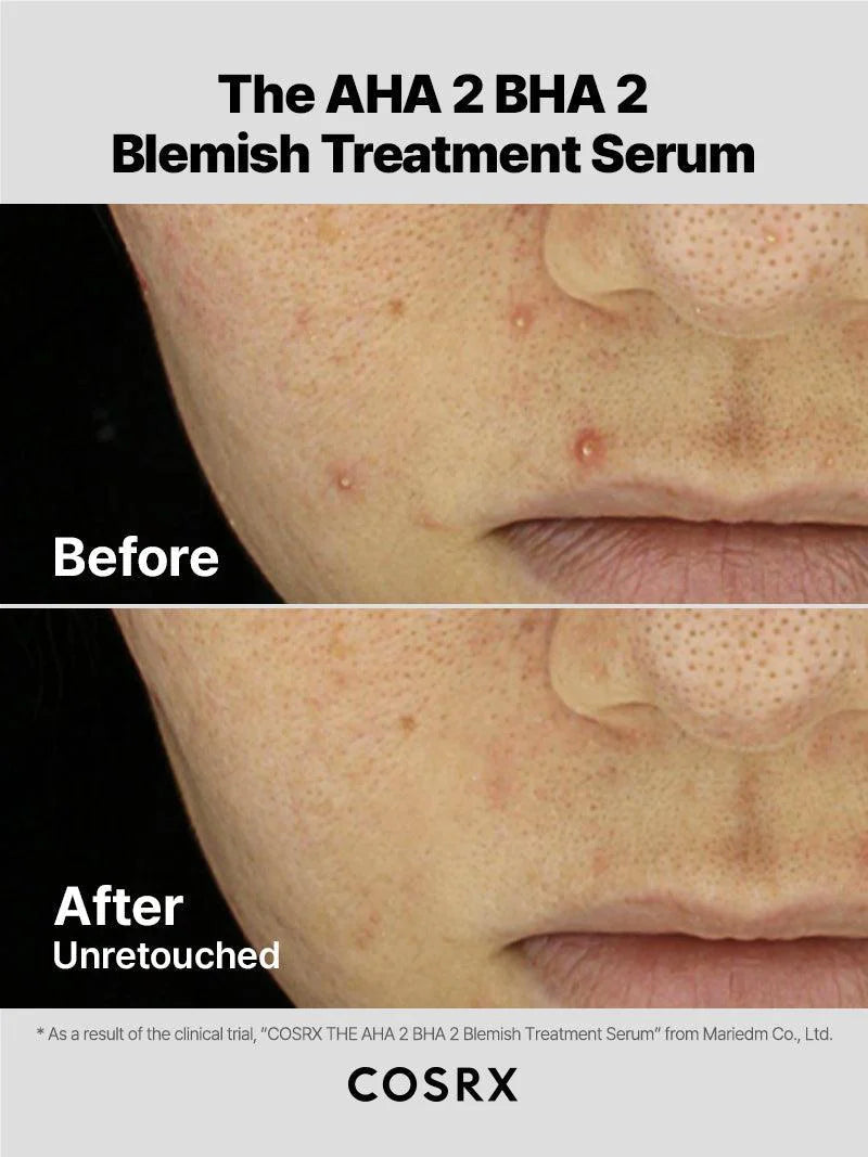 The AHA 2 BHA 2 Blemish Treatment Serum 50gr